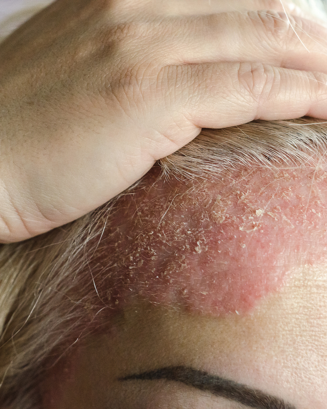 dermatite seborroica sulla cute sotto i capelli